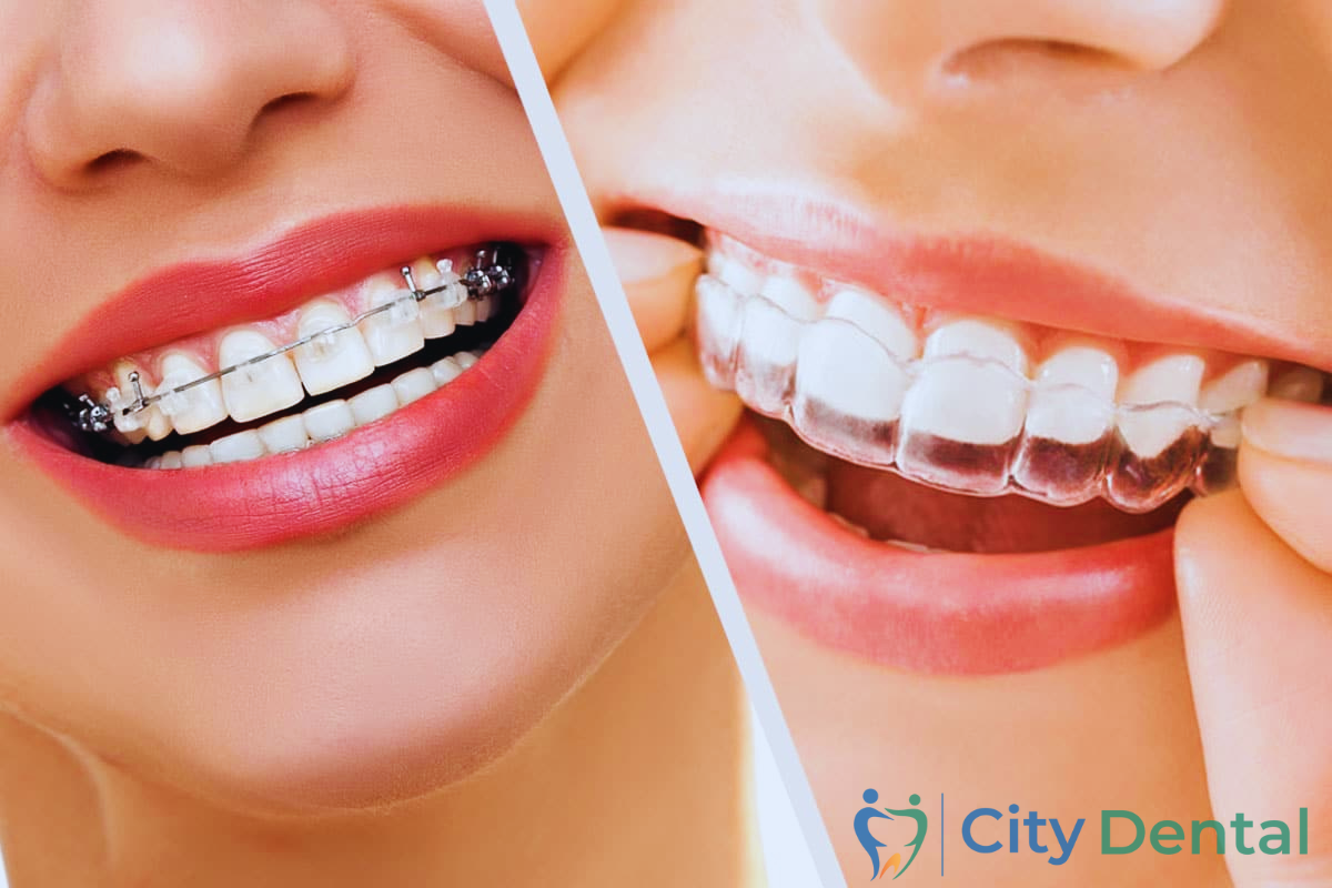 Orthodontic Braces and Aligners Treatment in Cuttack