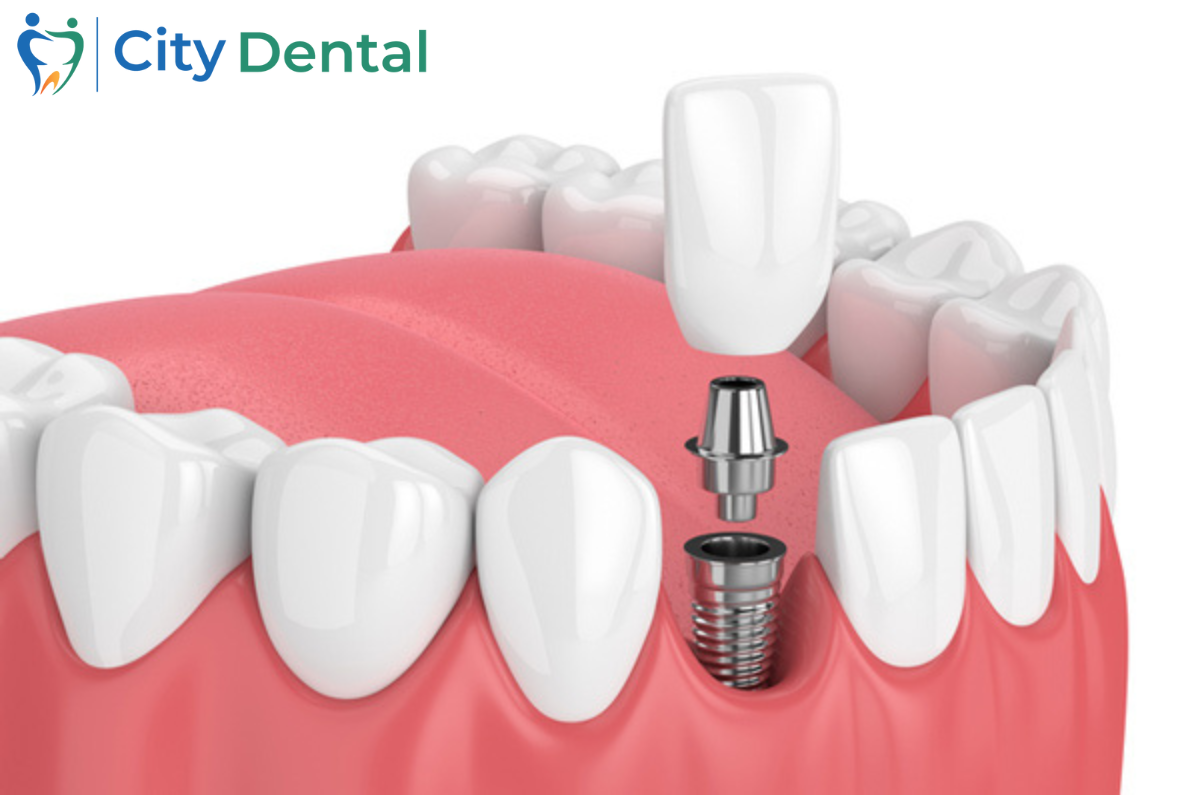 Dental Implants in Cuttack