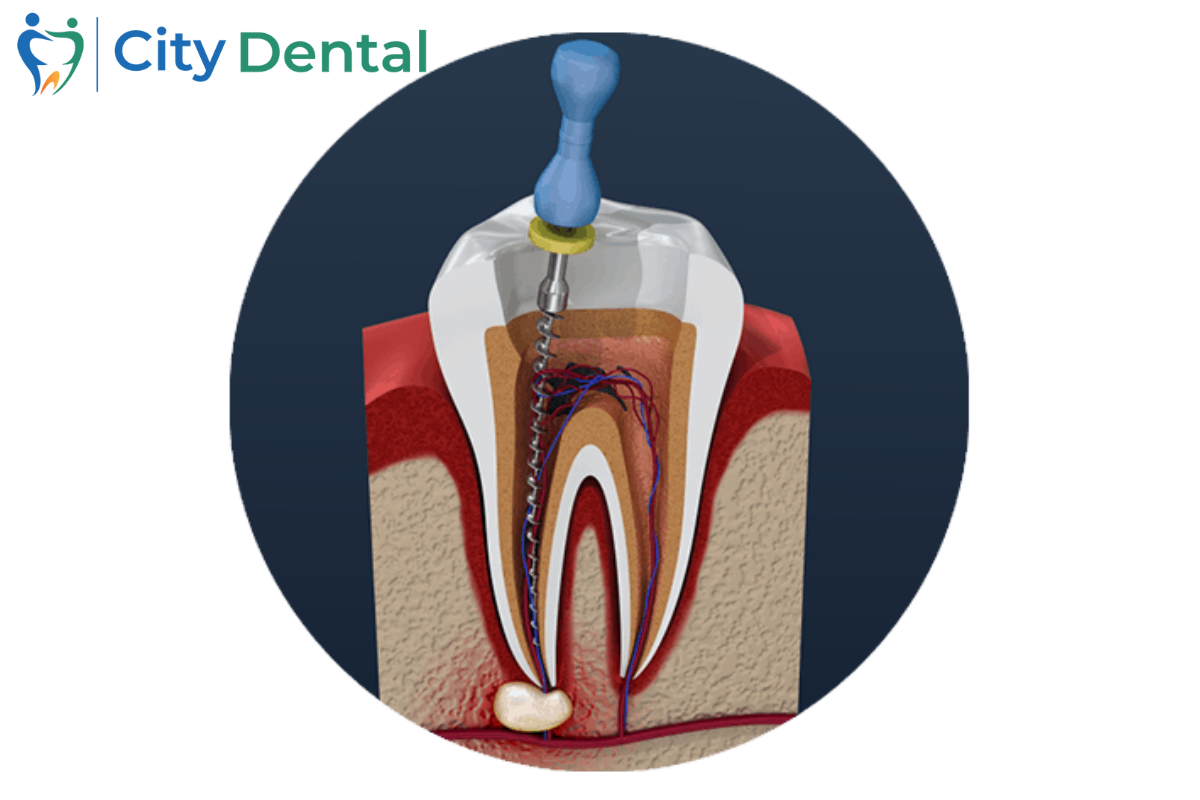 Root Canal Treatment in Cuttack